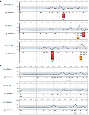 Case Report: Post-gastrectomy reactive hyperinsulinemic hypoglicaemia: glucose trends before and after canagliflozin treatment